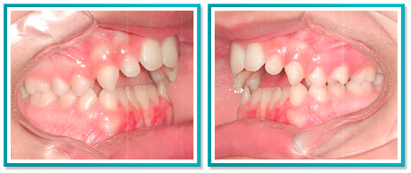 correção de dentes overjet